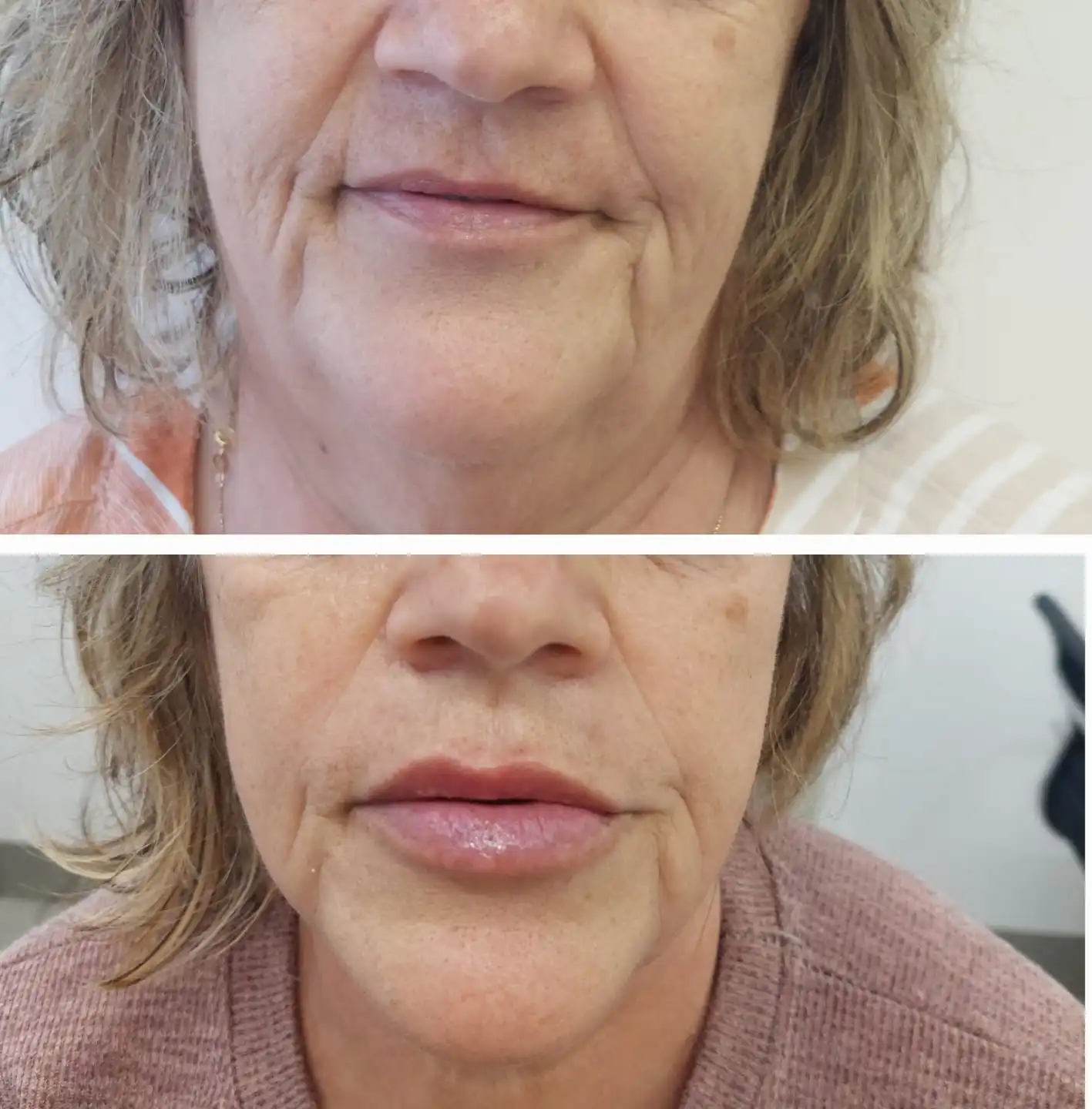 Comparação autorizada de antes e depois de harmonização facial em vista frontal