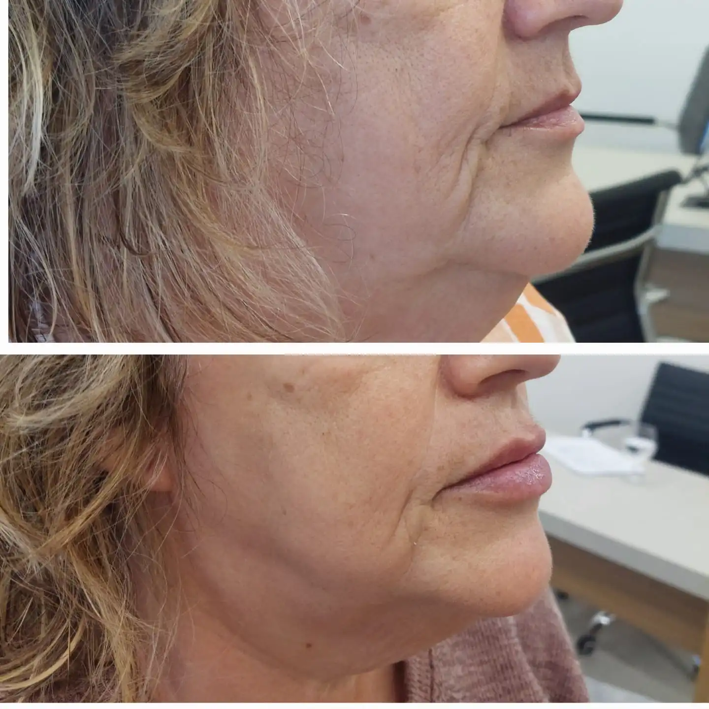 Comparação autorizada de antes e depois de harmonização facial em vista lateral