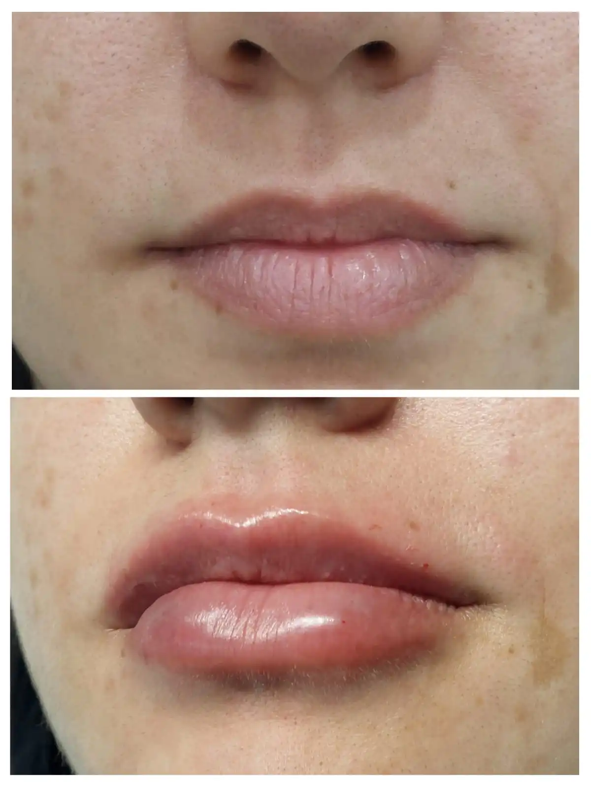 Comparação autorizada de antes e depois de preenchimento labial